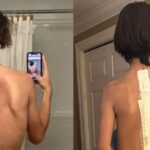 14-year-old Diagnosed with Scoliosis Underwent Operation By Spine Specialist