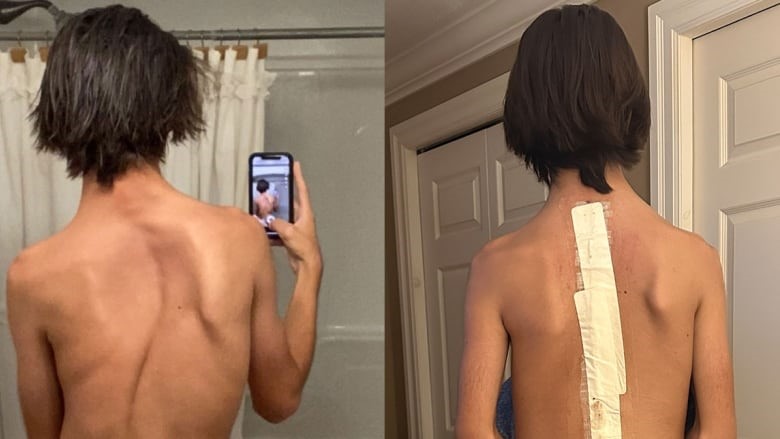 14-year-old Diagnosed with Scoliosis Underwent Operation By Spine Specialist